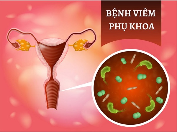 Viêm phụ khoa là gì – Dấu hiệu, nguyên nhân & cách điều trị